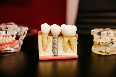 Dental Implants at Magis Dental - Setting the gold standard for replacing teeth.