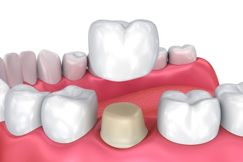Learn more about how a dental crown could help restore your smile at Magis Dental.