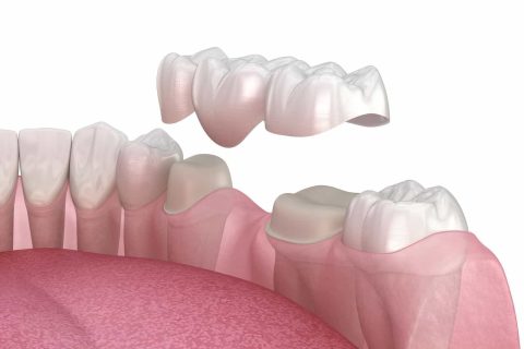 Porcelain Dental Veneers