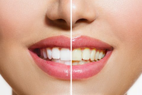 Tooth Whitening