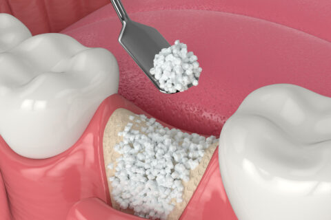 Bone graft for dental implants at Magis Dental.