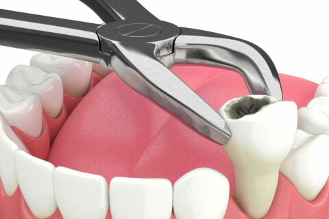 Simple and Surgical Extractions At Magis Dental