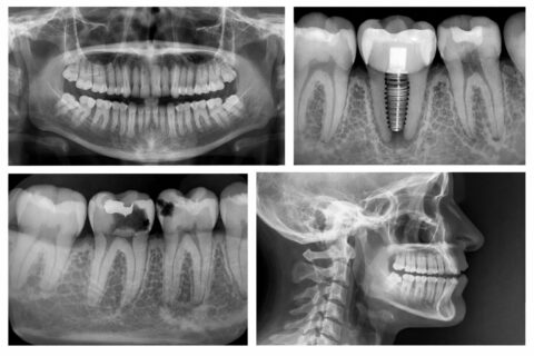 Digital X-Rays At Magis Dental In Joliet IL