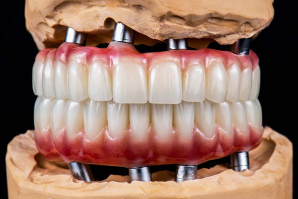 Dental,Photography,Of,Full,Arch,Zircon,Bridge,On,Implants full arch implant dentures Plainfield IL