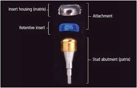 implant-denture-attachment implant retained denture attachment system